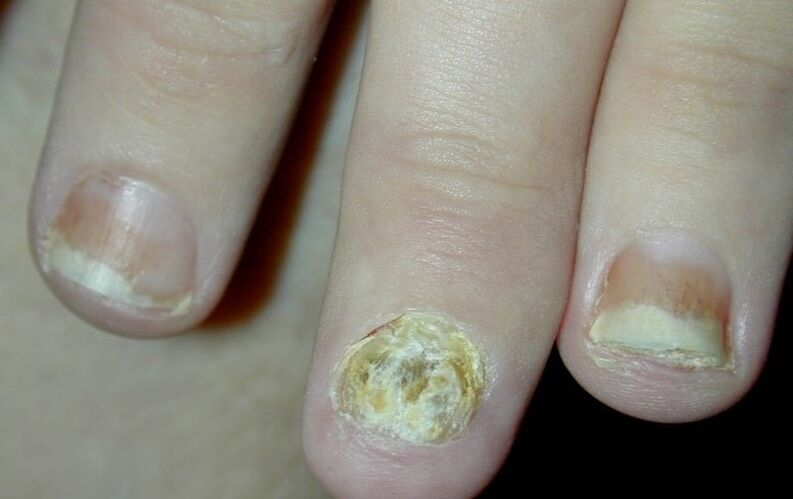 psoriasis of the fingernails