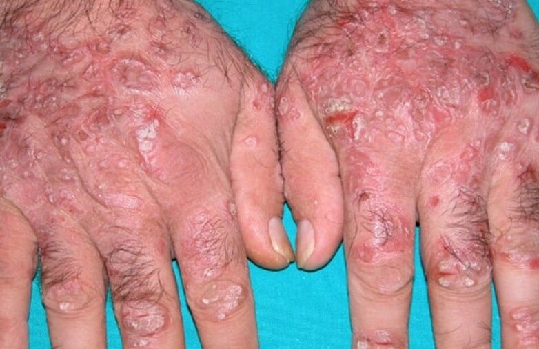 teardrop-shaped psoriasis on the hands