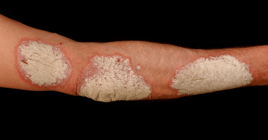 exudative psoriasis on the body