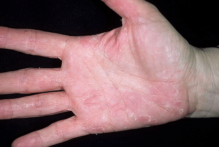 psoriasis of the palms and underside