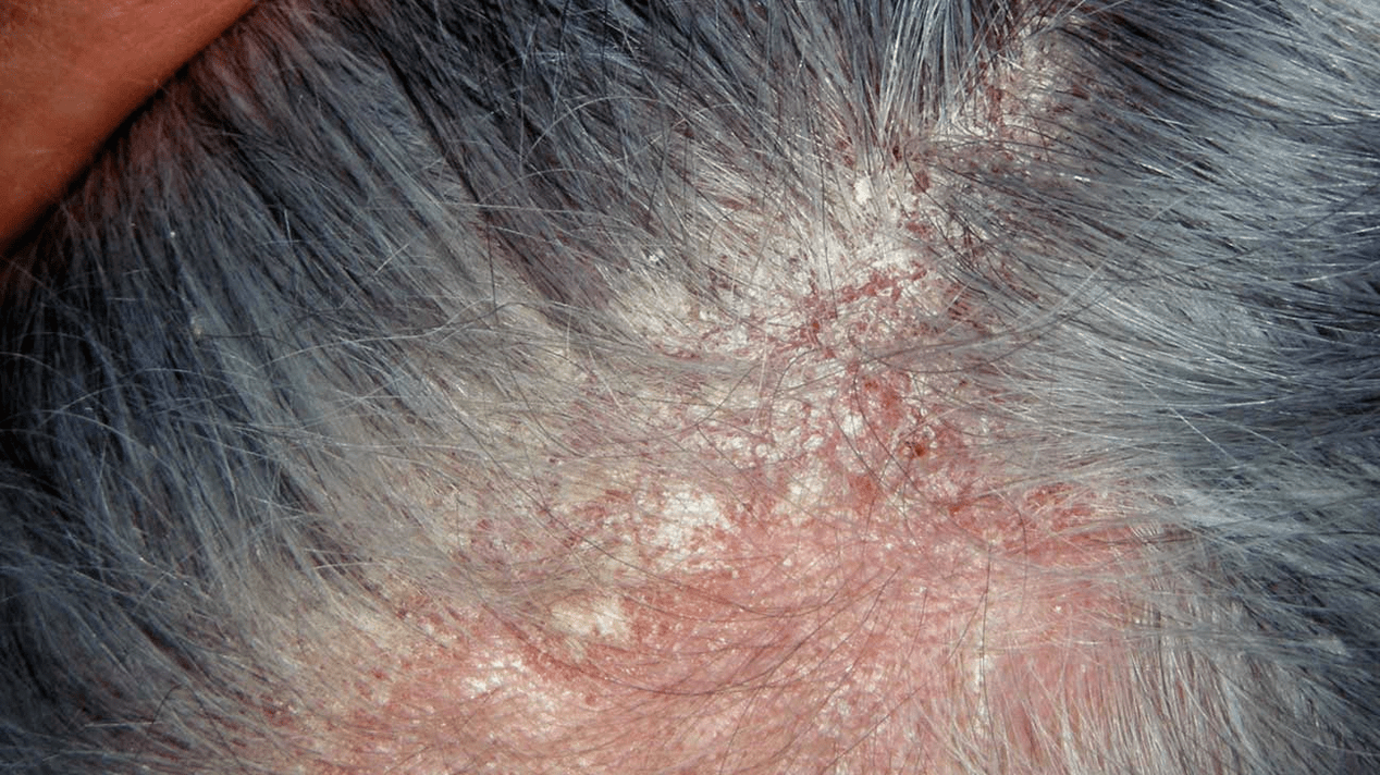 seborrheic psoriasis on the head