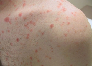 The initial phase of psoriasis