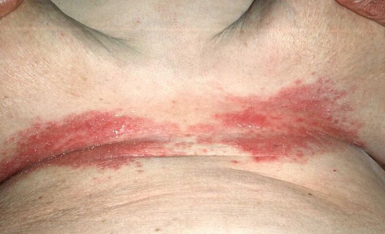 Psoriatic plaques under the breast