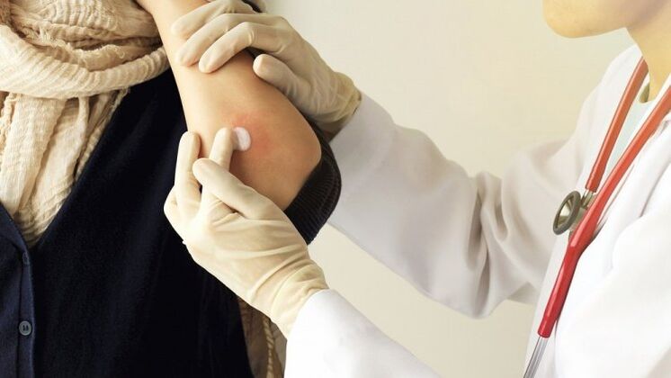 doctor smears elbow for psoriasis