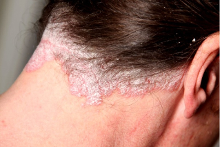 psoriasis wool of the head
