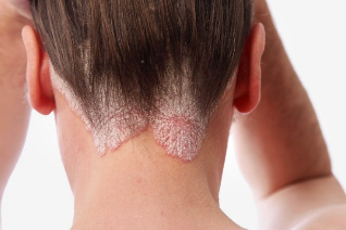 why does psoriasis wool of the head