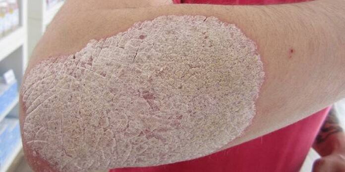 photo of psoriasis on the elbows