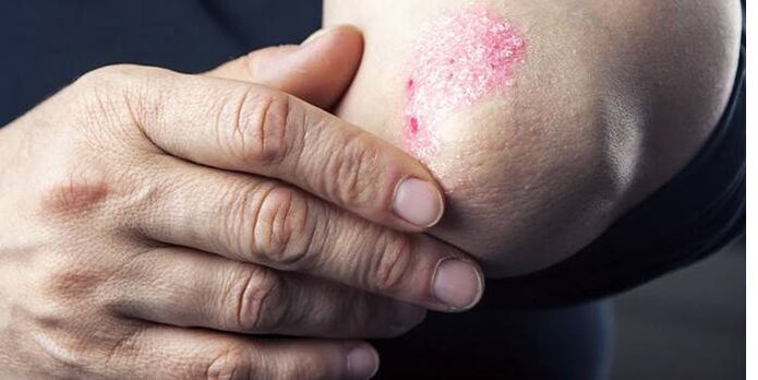symptoms of psoriasis on elbows