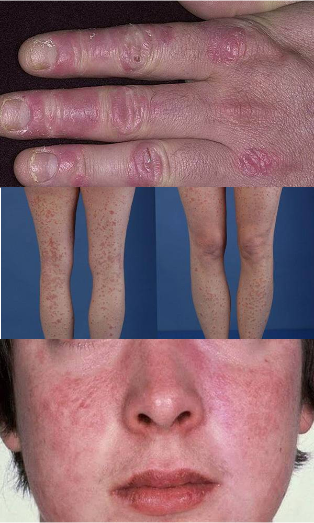 what looks like psoriasis on the hands, feet and face