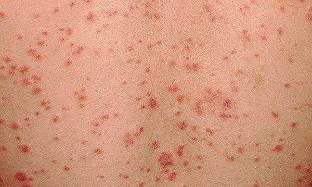 what looks like psoriasis the initial stage
