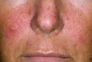 symptoms of psoriasis on the face