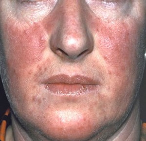 than to treat psoriasis on the face