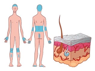The most common places of occurrence of psoriatic plaques