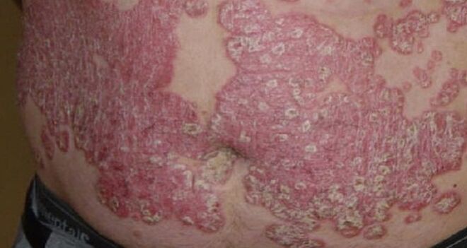 psoriasis on the stomach