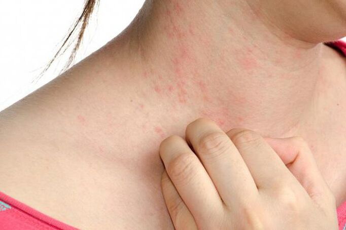 Exacerbation of psoriasis is manifested by rashes and severe itching