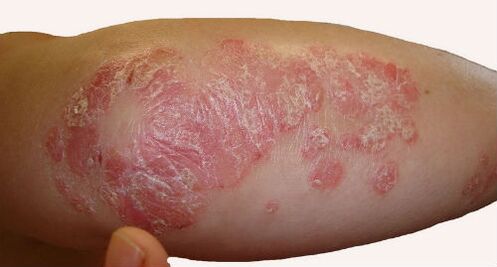 Scaly and bulky plaques on the elbow during an exacerbation of psoriasis