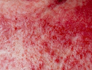 Advanced form of psoriasis