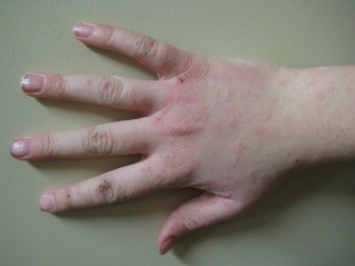 Early psoriasis