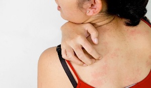 Psoriasis of the back
