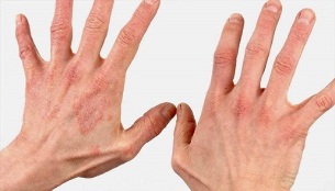 what the initial stage of psoriasis looks like