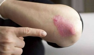 stationary stage of psoriasis development