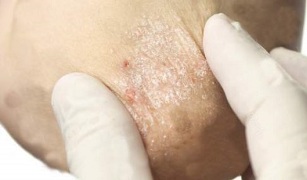 treatment of psoriasis in the easing phase