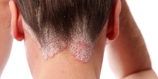 treatment of psoriasis