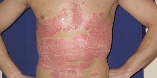 guidance on the comprehensive treatment of psoriasis