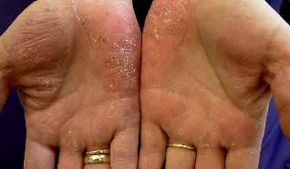 products for psoriasis