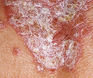 Stationary stage of psoriasis