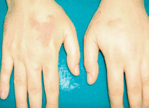 The localization of the disease on the hands