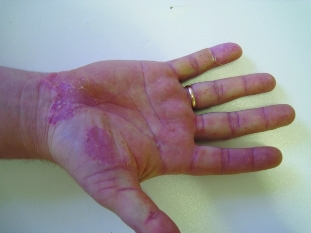 Pustules of the palms and soles of the feet