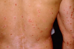 psoriasis the initial stage